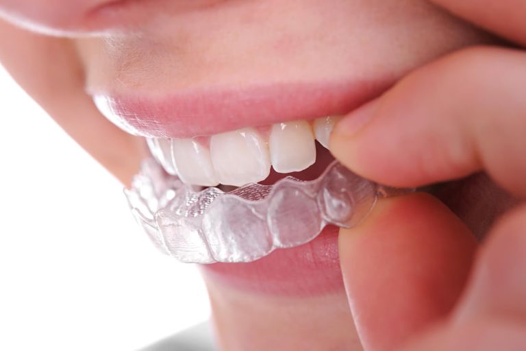 Niềng răng Ecligner là công nghệ niềng răng trong suốt hiện đại