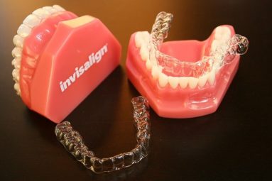 Niềng răng hô bằng nhựa là phương pháp chỉnh nha hiện đại nhất hiện nay