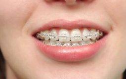 Niềng răng hô hàm: Quy trình, chi phí và địa chỉ thực hiện uy tín