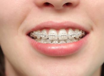 Niềng răng hô hàm: Quy trình, chi phí và địa chỉ thực hiện uy tín