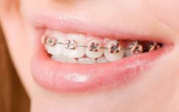 Niềng răng không phải phương pháp điều trị hiệu quả với trường hợp hô nướu