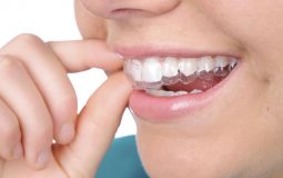 Niềng răng Leetray là gì? Có tốt không và khi nào nên thực hiện? 