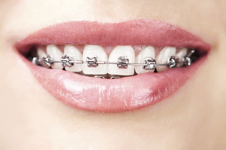 Niềng răng sắt là phương pháp chỉnh nha đã có từ lâu đời