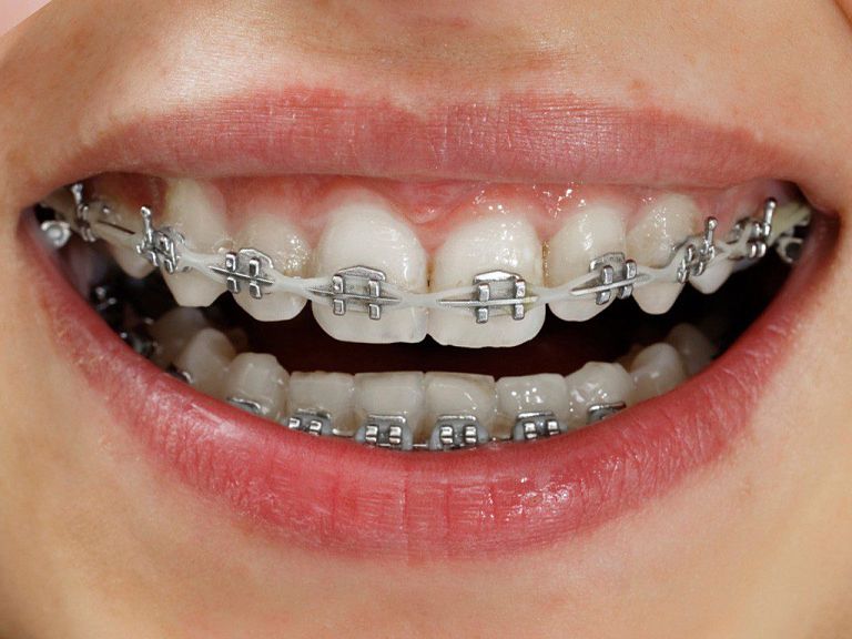 Niềng răng sắt có các ưu và nhược điểm 