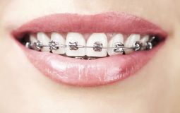 Niềng răng sắt là gì? Ưu nhược điểm và quy trình thực hiện