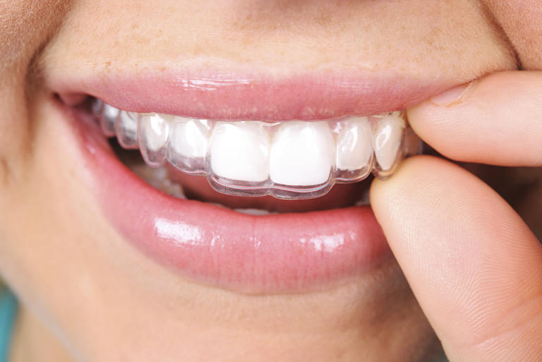 Niềng răng Clear Aligner không thật sự hiệu quả khi mắc các khiếm khuyết nặng trên răng