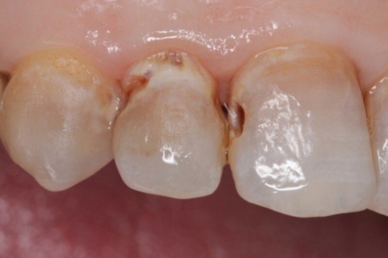 Sâu kẽ răng cần sớm được điều trị để tránh những ảnh hưởng về sau