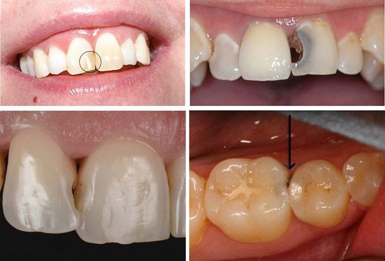 Hình ảnh bệnh nhân bị sâu khe răng thường thấy