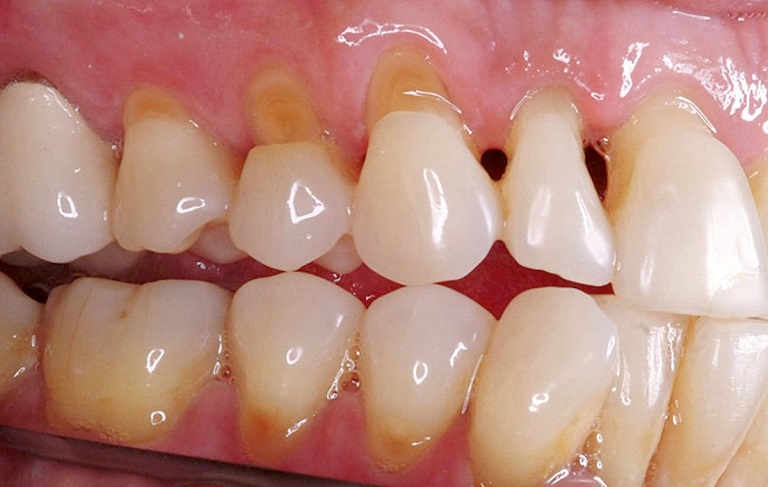 Sâu khe răng cũng phát triển theo từng giai đoạn khác nhau