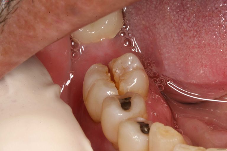Sâu răng hàm là bệnh lý khá phổ biến mà ai cũng có thể mắc phải