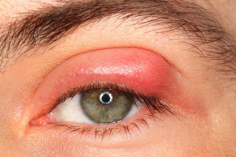 Người bệnh có thể bị sưng hoặc sụp mí mắt