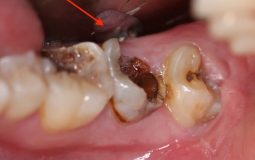 Trường hợp sâu răng phát triển năng, bắt buộc loại bỏ phần tủy răng