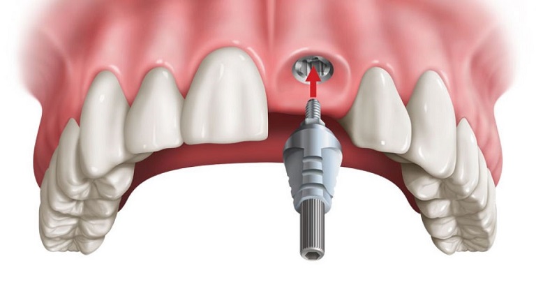 Răng Implant thường có tính thẩm mỹ cao do sở hữu hình dáng giống răng thật