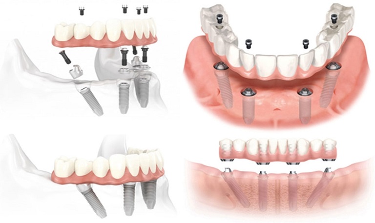 Độ bền của răng giả tháo lắp trên trụ Implant thường rất cao