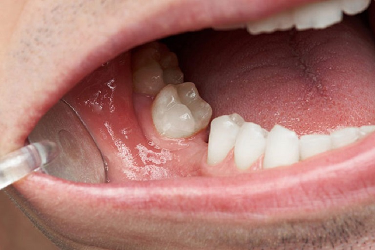 Vệ sinh răng miệng kém là nguyên nhân chính gây ra tình trạng mất răng hàm, chiếm khoảng 80%