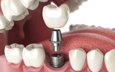 Cấy ghép Implant được coi là giải pháp tối ưu nhất hiện nay