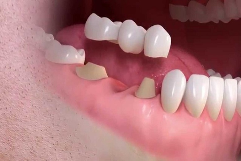 Cầu răng sứ giúp bệnh nhân có thể ăn nhai được tốt