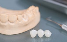 Trồng răng sứ là một trong những phương pháp thẩm mỹ nha khoa hiện đại
