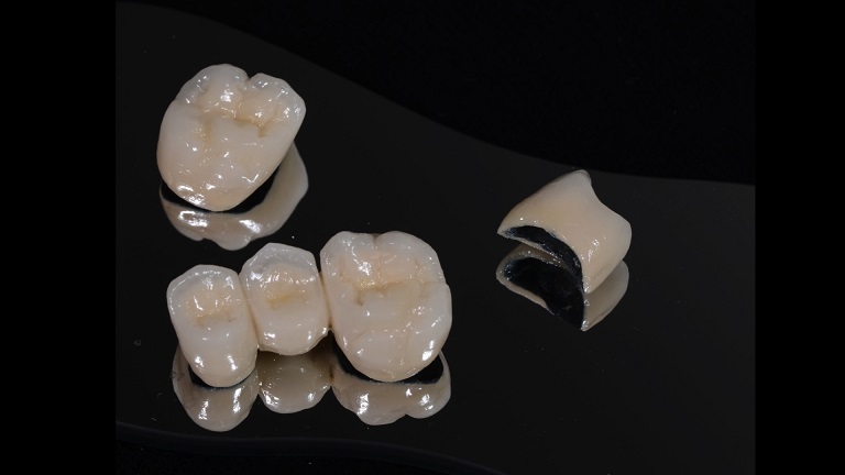 Răng sứ titan thường có cấu tạo giống với răng sứ kim loại