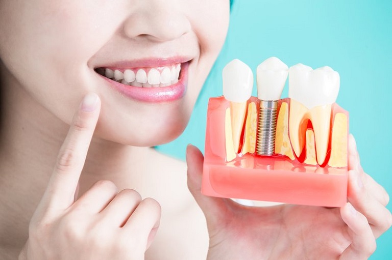 Chất liệu trụ Implant cũng được đánh giá là an toàn với sức khỏe