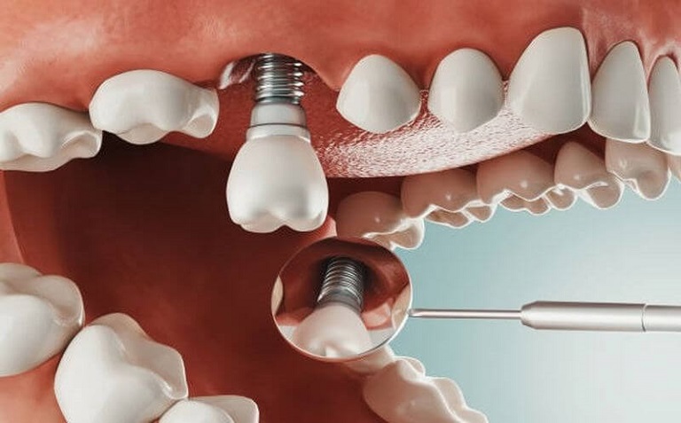 Trồng răng Implant giúp khôi phục phần chân răng và thân răng hoàn hảo