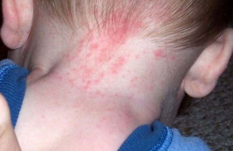 Trẻ bị nổi mẩn đỏ trên đầu có ảnh hưởng sức khỏe không?