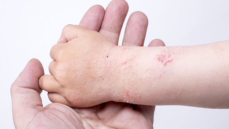 Bệnh á sừng ở trẻ em là tình trạng da bị khô ráp, nứt nẻ, bong tróc vảy thành từng mảng