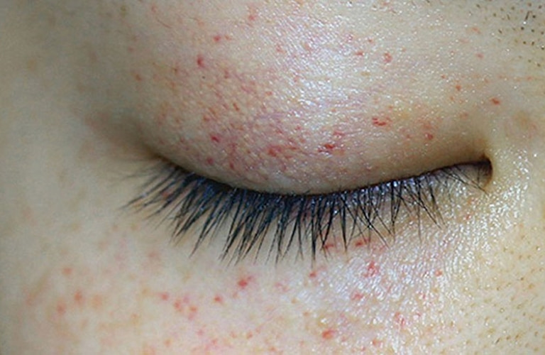 Bị nổi mẩn đỏ quanh mắt là dấu hiệu cảnh báo bệnh nổi mề đay