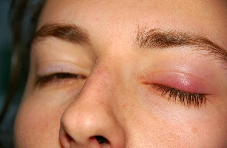 Bị nổi mẩn đỏ quanh mắt không nguy hiểm đến tính mạnh nhưng không được chủ quan