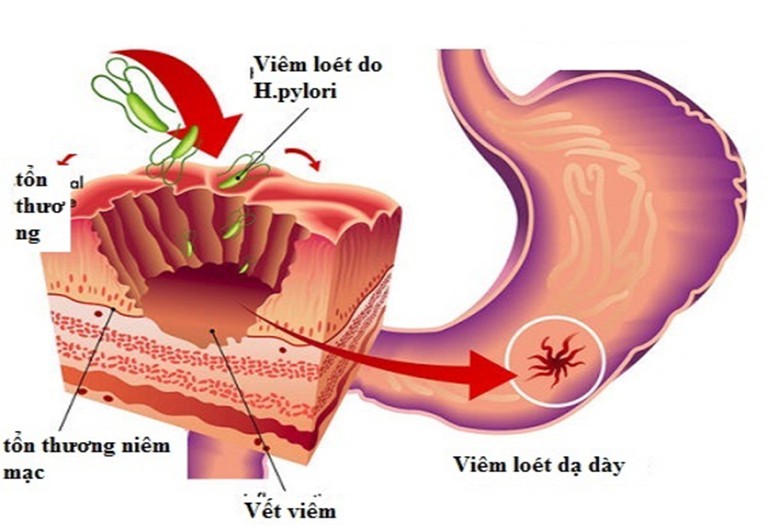 Viêm dạ dày mãn tính nếu không được chữa trị kịp thời có thể gây ra ung thư