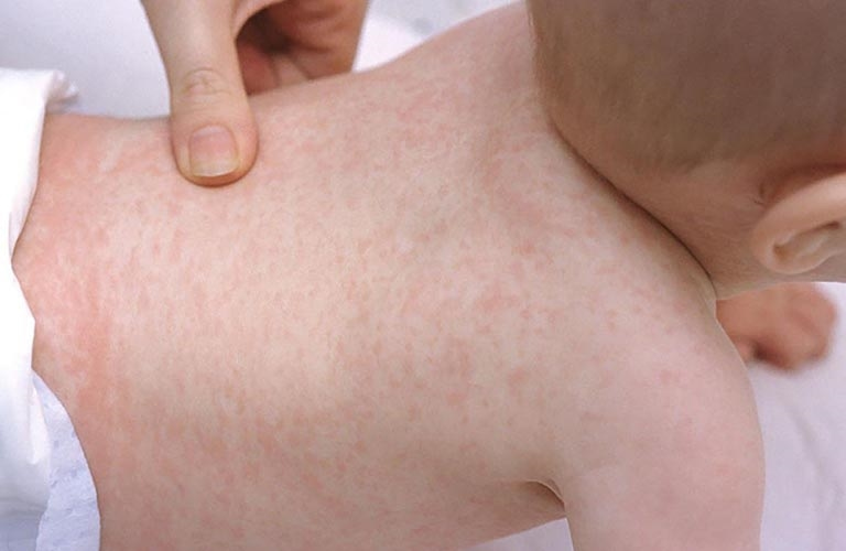 Sốt phát ban là tình trạng trẻ sốt cao kèm thêm các nốt đỏ chìm hoặc nhô trên bề mặt da