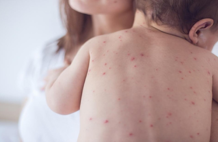 Nổi mẩn đỏ và sốt ở trẻ nhỏ nguy hiểm nếu không điều trị đúng cách