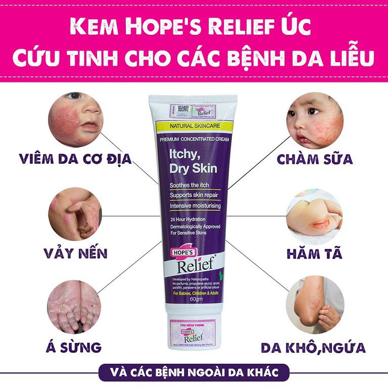 Hết á sừng nhờ kem bôi Hope’s Relief