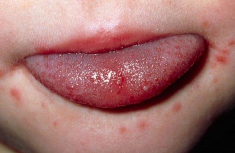 Trẻ nhỏ đùa giỡn hoặc mọc răng sẽ chảy nhiều nước bọt và dính xung quanh miệng