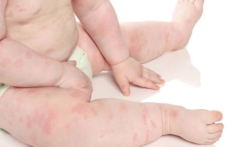 Nổi mẩn đỏ ở chân trẻ sơ sinh có thể là dấu hiệu của sốt phát ban