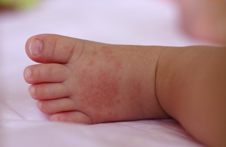 Dấu hiệu của bệnh tổ đỉa ở trẻ sơ sinh là mẩn đỏ chứa nước