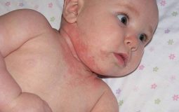 Trẻ sơ sinh bị nổi mẩn đỏ ở cổ: Nguyên nhân và cách điều trị hiệu quả