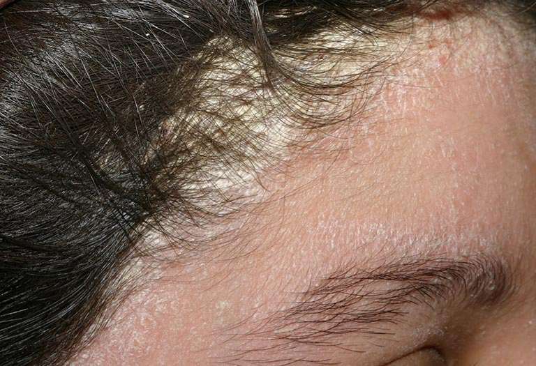 Bệnh á sừng da đầu khiến nhiều người lo lắng