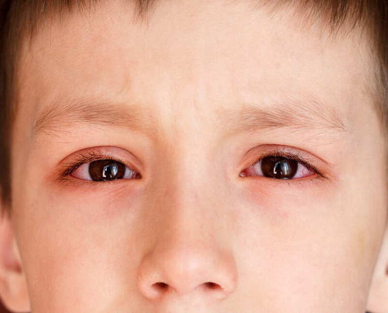 Trường hợp nặng trẻ có thể bị mù mắt một cách đột ngột