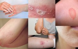 Có nhiều loại bệnh viêm da khác nhau