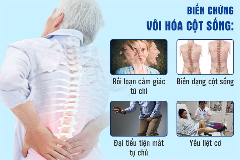 Vôi hóa cột sống gây nhiều biến chứng nguy hiểm