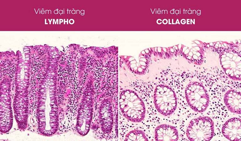 Viêm đại tràng vi thể lympho và collagen
