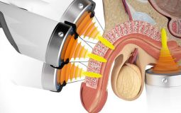 Điều Trị Rối Loạn Cương Dương Bằng Sóng Xung Kích Thế Nào?