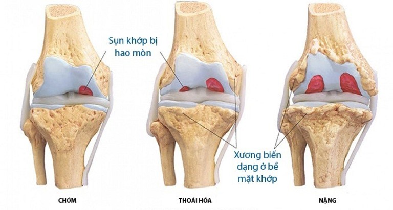 Thoái hóa khớp là bệnh lý xương khớp mạn tính