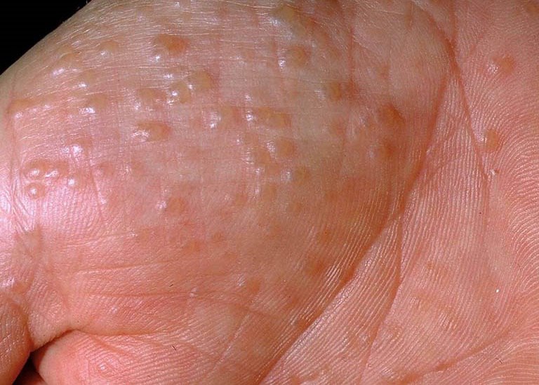 Tổ đỉa chàm dạng trứng sam có biểu hiện đặc trưng đó là hình thành mụn nước ở bàn tay