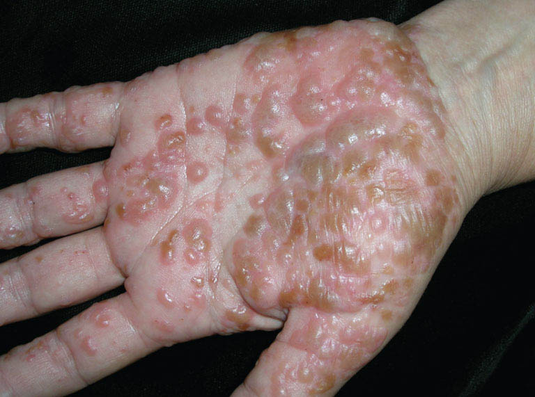 Người bệnh tuyệt đối không được chọc vào các mụn nước trên da