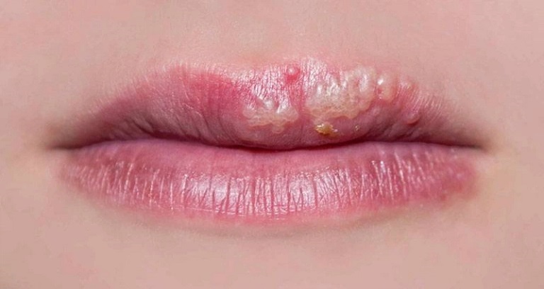 Bệnh tổ đỉa ở môi gây ngứa ngáy khó chịu