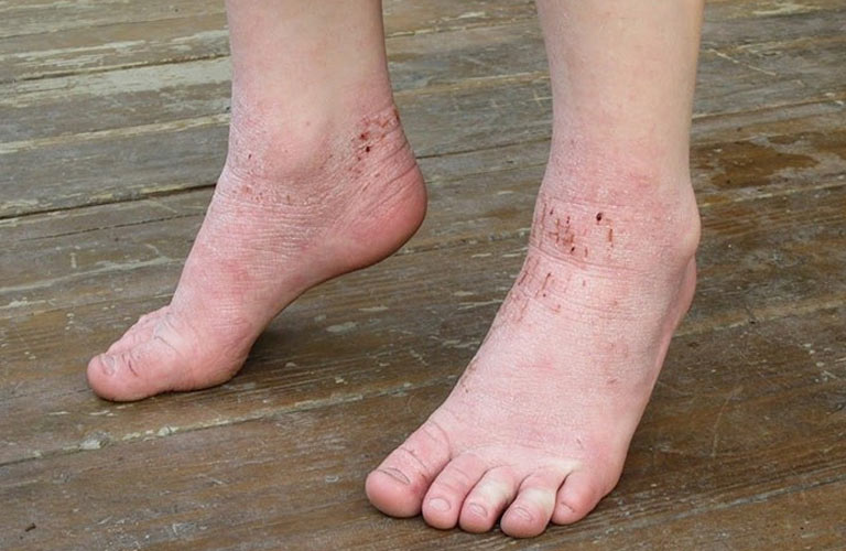 Viêm da cơ địa ở chân gây ảnh hưởng đến cuộc sống của người bệnh