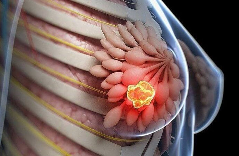 Trong trường hợp nghiêm trọng, bệnh nhân có thể bị ung thư vú