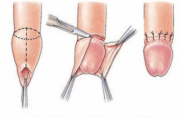 Cắt bao quy đầu xong có đau không? Câu trả lời là có